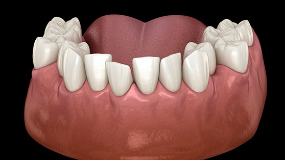 Illustration of crowded teeth