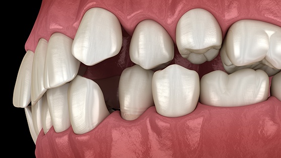 Illustration of gapped teeth