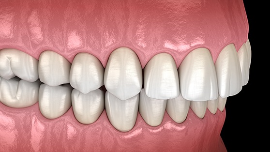 Illustration of an overbite