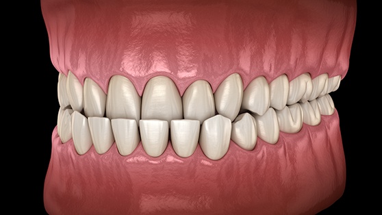 Illustration of an underbite