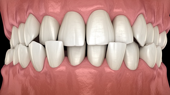 Illustration of a crossbite