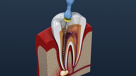a 3D illustration demonstrating the root canal process