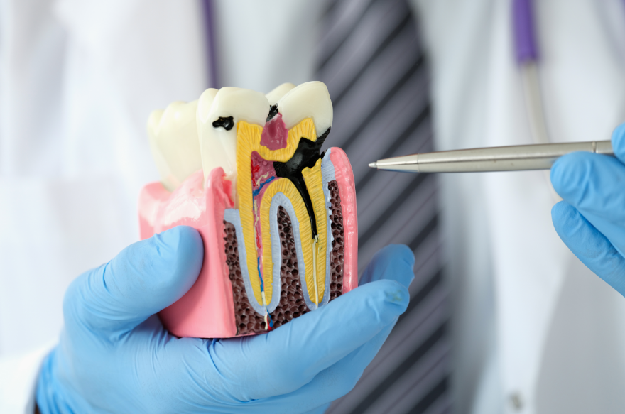 Dental model of a cavity