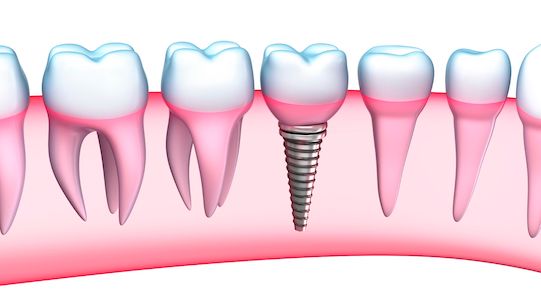 diagram of a dental implant