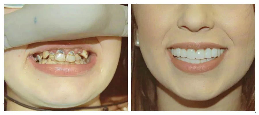 before and after of a patient who had full mouth reconstruction surgery at Sunnyvale Family and Cosmetic Dentistry
