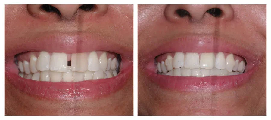 before and after photos of a patient who had their teeth straigtened with Invisalign and then whitened