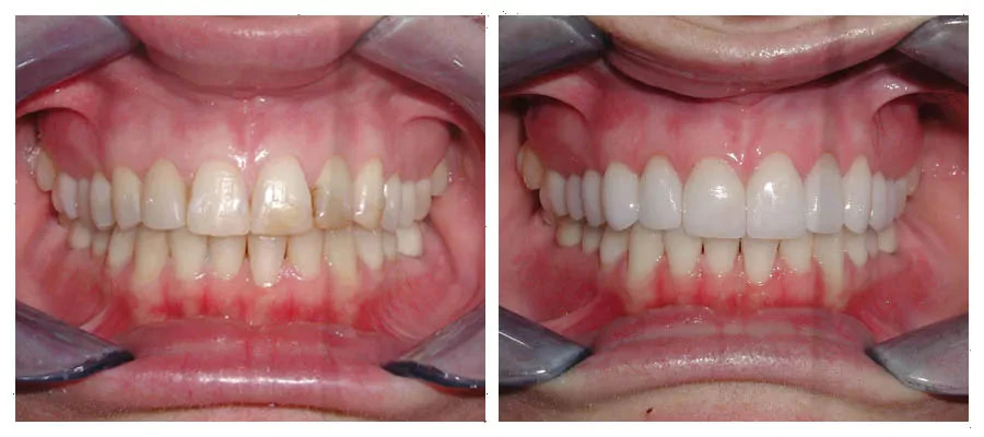 patient who received 8 dental veneers after car accident
