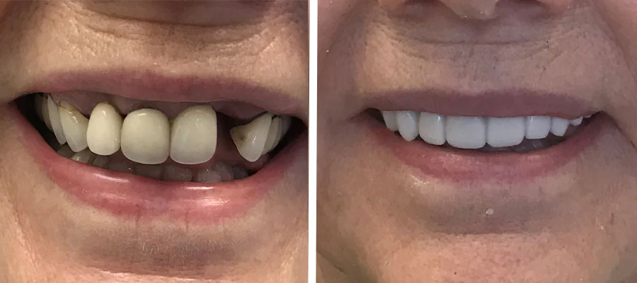 immediate denture